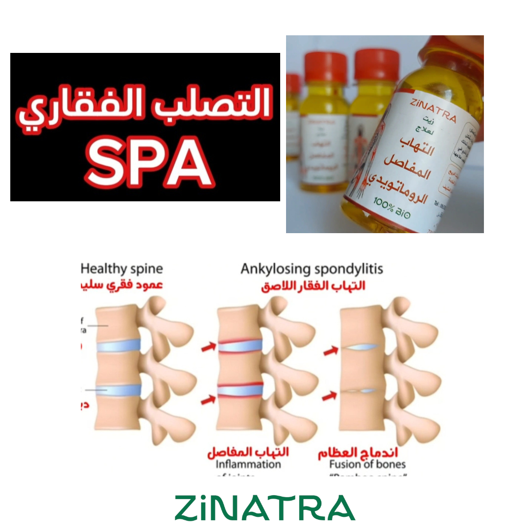 لالتهاب المفاصل والأوتار ZiNATRA  زيت التدليك